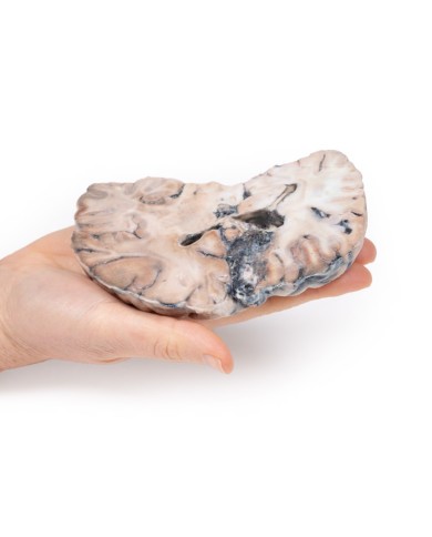 Malformazione Arterio Venosa Cerebrale Erler Zimmer 3D anatomy Series MP2