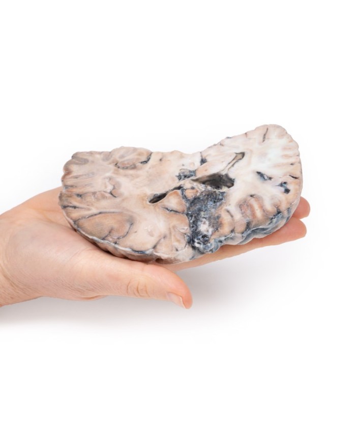 Malformazione Arterio Venosa Cerebrale Erler Zimmer 3D anatomy Series MP2 Malformazione Arterio Venosa Cerebrale Erler Zimmer 3D anatomy Series MP2