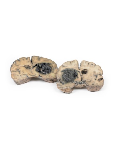 Emorragia intracerebrale Erler Zimmer 3D anatomy Series MP2012