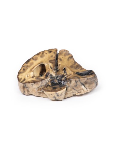 Lesione intracranica Erler Zimmer 3D anatomy Series MP2011