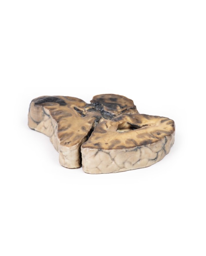 Lesione intracranica Erler Zimmer 3D anatomy Series MP2011 Lesione intracranica Erler Zimmer 3D anatomy Series MP2011