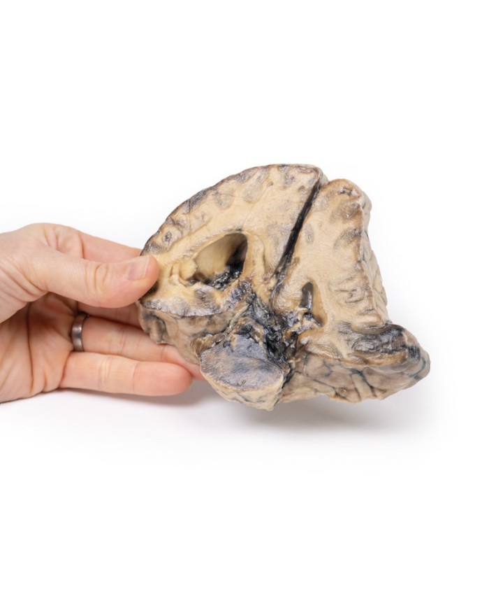 Lesione intracranica Erler Zimmer 3D anatomy Series MP2011 Lesione intracranica Erler Zimmer 3D anatomy Series MP2011