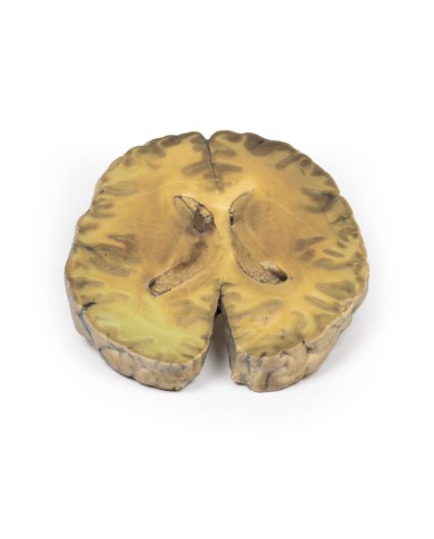 Ventricolite secondaria a setticemia Erler Zimmer 3D anatomy Series MP20