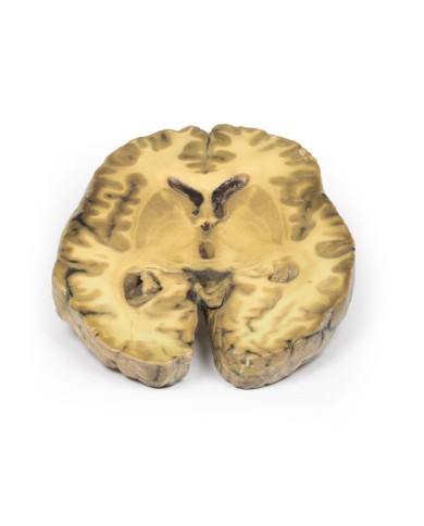 Ventricolite secondaria a setticemia Erler Zimmer 3D anatomy Series MP20