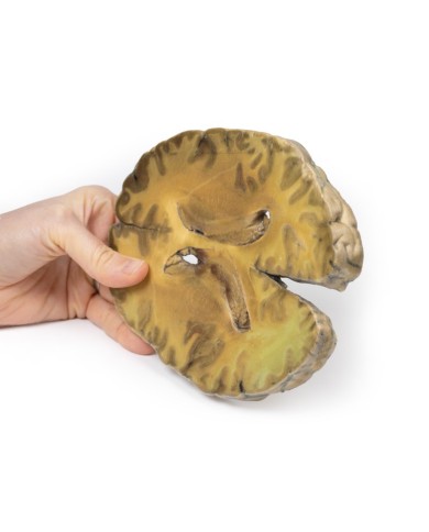 Ventricolite secondaria a setticemia Erler Zimmer 3D anatomy Series MP20