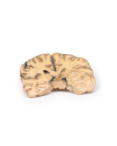 Astrocitoma Erler Zimmer 3D anatomy Series MP2014