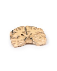 Astrocitoma Erler Zimmer 3D anatomy Series MP2014 Astrocitoma Erler Zimmer 3D anatomy Series MP2014