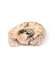 Glioblastoma multiforme Erler Zimmer 3D anatomy Series MP2016 Glioblastoma multiforme Erler Zimmer 3D anatomy Series MP2016