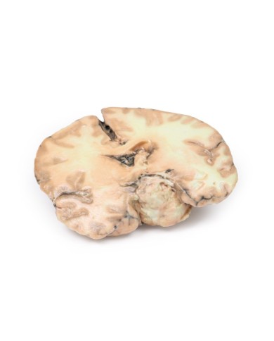 Glioblastoma multiforme Erler Zimmer 3D anatomy Series MP2016