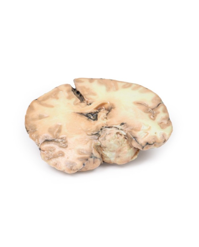 Glioblastoma multiforme Erler Zimmer 3D anatomy Series MP2016 Glioblastoma multiforme Erler Zimmer 3D anatomy Series MP2016