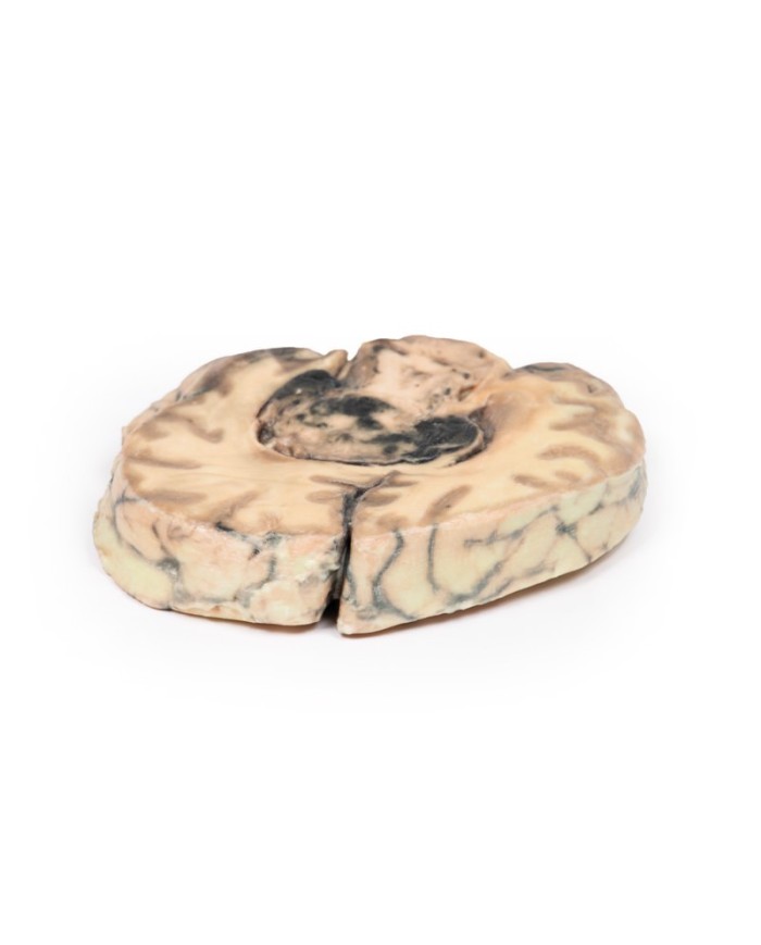 Glioblastoma multiforme Erler Zimmer 3D anatomy Series MP2016 Glioblastoma multiforme Erler Zimmer 3D anatomy Series MP2016