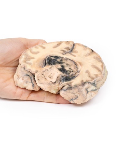 Glioblastoma multiforme Erler Zimmer 3D anatomy Series MP2016 Glioblastoma multiforme Erler Zimmer 3D anatomy Series MP2016