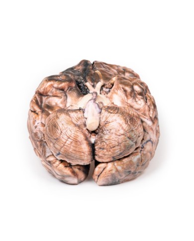 Aneurisma sacculare Erler Zimmer 3D anatomy Series MP2013