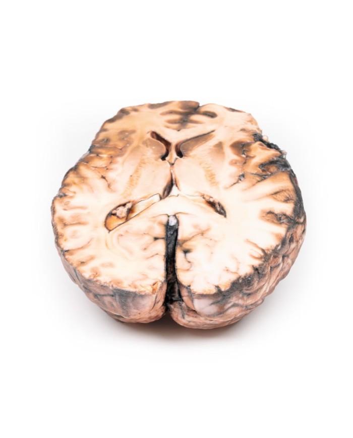 Aneurisma sacculare Erler Zimmer 3D anatomy Series MP2013 Aneurisma sacculare Erler Zimmer 3D anatomy Series MP2013