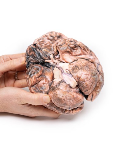 Aneurisma sacculare Erler Zimmer 3D anatomy Series MP2013 Aneurisma sacculare Erler Zimmer 3D anatomy Series MP2013