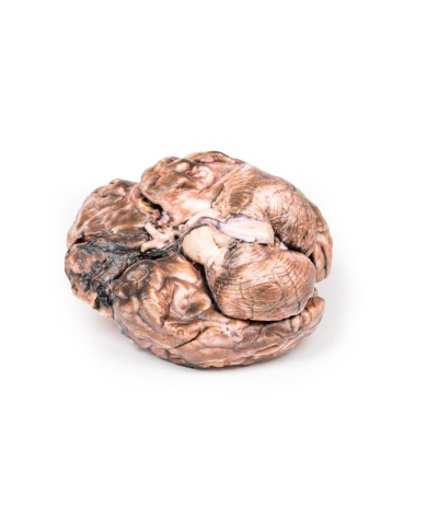 Aneurisma sacculare Erler Zimmer 3D anatomy Series MP2013 Aneurisma sacculare Erler Zimmer 3D anatomy Series MP2013