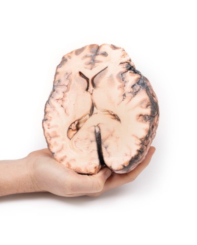 Aneurisma sacculare Erler Zimmer 3D anatomy Series MP2013 Aneurisma sacculare Erler Zimmer 3D anatomy Series MP2013