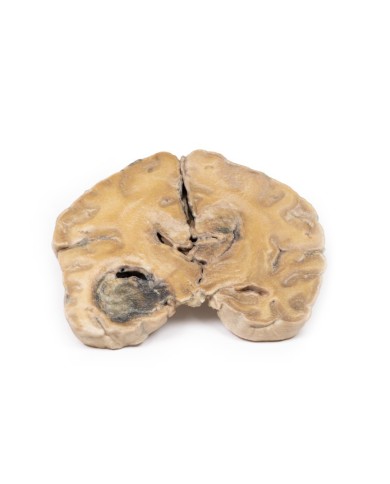 Glioblastoma multiforme Erler Zimmer 3D anatomy Series MP2015