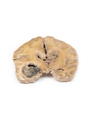 Glioblastoma multiforme Erler Zimmer 3D anatomy Series MP2015 Glioblastoma multiforme Erler Zimmer 3D anatomy Series MP2015