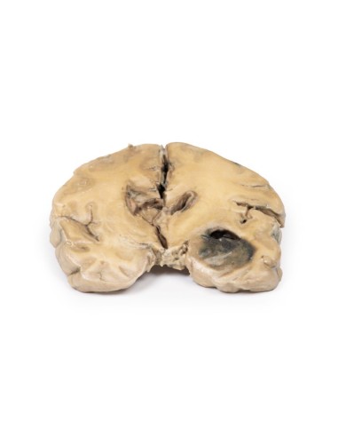 Glioblastoma multiforme Erler Zimmer 3D anatomy Series MP2015