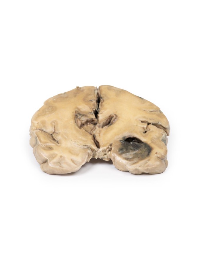 Glioblastoma multiforme Erler Zimmer 3D anatomy Series MP2015 Glioblastoma multiforme Erler Zimmer 3D anatomy Series MP2015