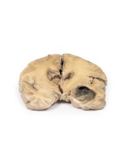 Glioblastoma multiforme Erler Zimmer 3D anatomy Series MP2015 Glioblastoma multiforme Erler Zimmer 3D anatomy Series MP2015