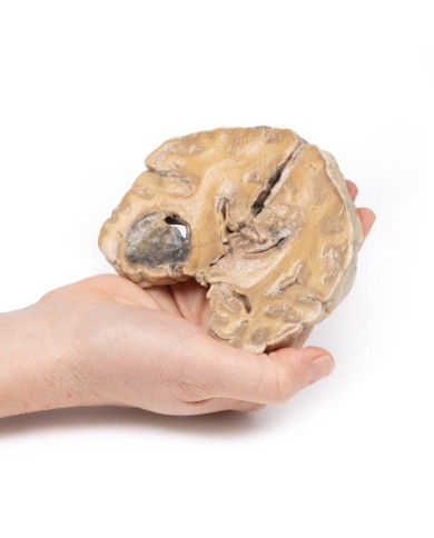 Glioblastoma multiforme Erler Zimmer 3D anatomy Series MP2015 Glioblastoma multiforme Erler Zimmer 3D anatomy Series MP2015