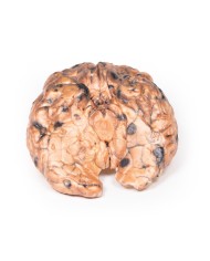 Melanoma metastatico Erler Zimmer 3D anatomy Series MP2018 Melanoma metastatico Erler Zimmer 3D anatomy Series MP2018