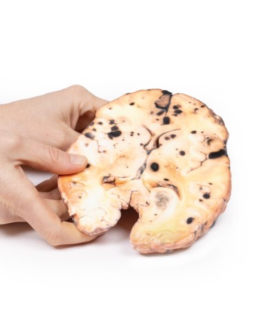 Melanoma metastatico Erler Zimmer 3D anatomy Series MP2018