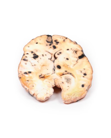 Melanoma metastatico Erler Zimmer 3D anatomy Series MP2018 Melanoma metastatico Erler Zimmer 3D anatomy Series MP2018