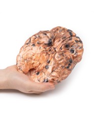 Melanoma metastatico Erler Zimmer 3D anatomy Series MP2018 Melanoma metastatico Erler Zimmer 3D anatomy Series MP2018