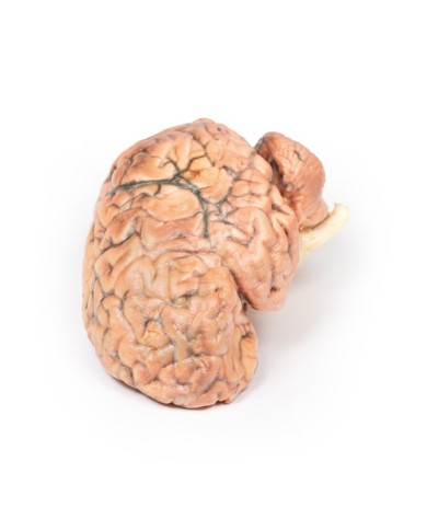 Craniofaringioma Erler Zimmer 3D anatomy Series MP2017