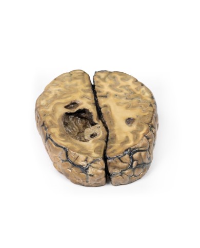 Carcinoma metastatico nel cervello Erler Zimmer 3D anatomy Series MP2019