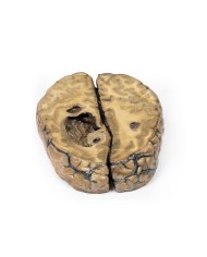 Carcinoma metastatico nel cervello Erler Zimmer 3D anatomy Series MP2019 Carcinoma metastatico nel cervello Erler Zimmer 3D anatomy Series MP2019