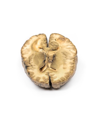 Carcinoma metastatico nel cervello Erler Zimmer 3D anatomy Series MP2019