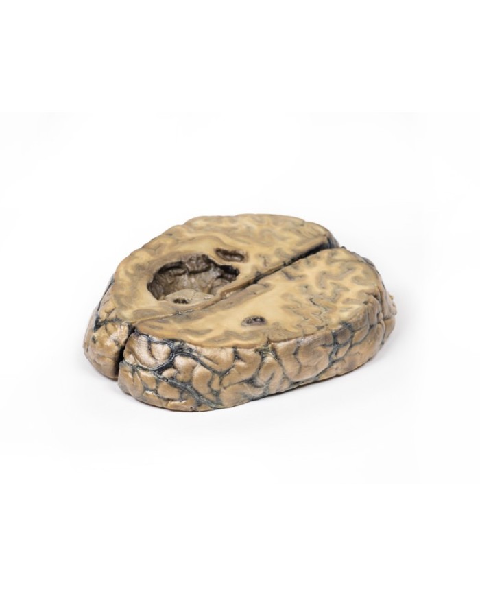 Carcinoma metastatico nel cervello Erler Zimmer 3D anatomy Series MP2019 Carcinoma metastatico nel cervello Erler Zimmer 3D anatomy Series MP2019