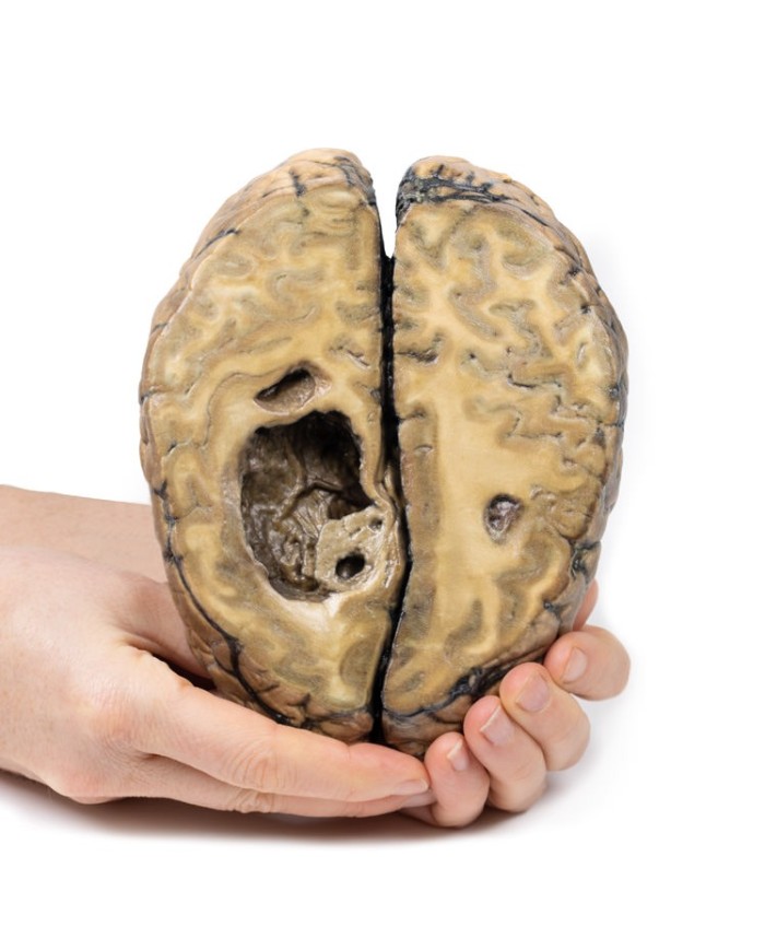 Carcinoma metastatico nel cervello Erler Zimmer 3D anatomy Series MP2019 Carcinoma metastatico nel cervello Erler Zimmer 3D anatomy Series MP2019