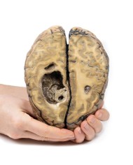 Carcinoma metastatico nel cervello Erler Zimmer 3D anatomy Series MP2019 Carcinoma metastatico nel cervello Erler Zimmer 3D anatomy Series MP2019