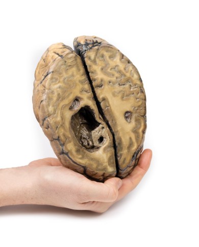 Carcinoma metastatico nel cervello Erler Zimmer 3D anatomy Series MP2019 Carcinoma metastatico nel cervello Erler Zimmer 3D anatomy Series MP2019