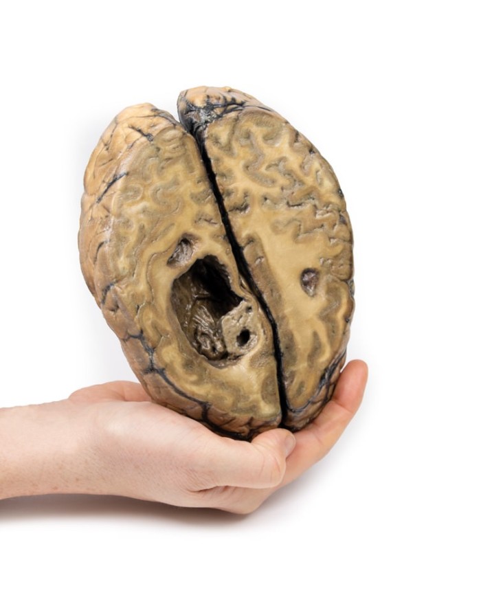 Carcinoma metastatico nel cervello Erler Zimmer 3D anatomy Series MP2019 Carcinoma metastatico nel cervello Erler Zimmer 3D anatomy Series MP2019