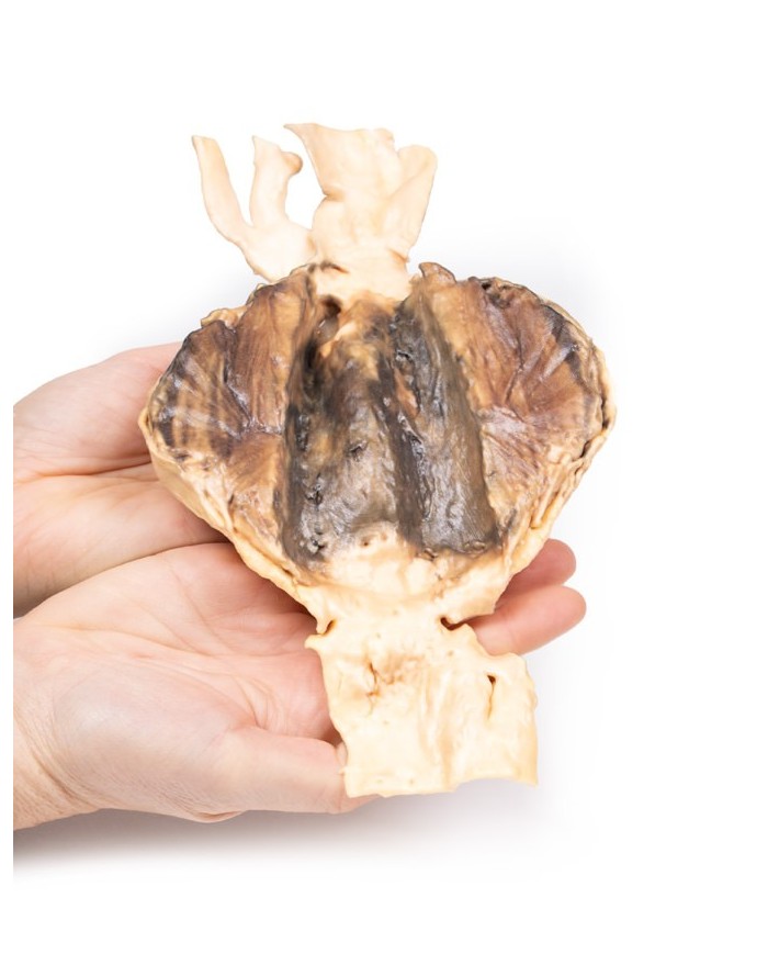 Aneurisma dell aorta addominale Erler Zimmer 3D anatomy Series MP2030