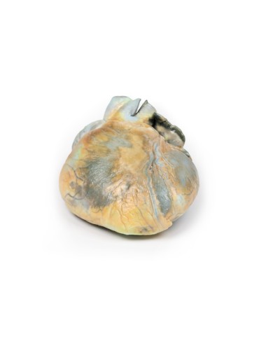 Ipertrofia ventricolare destra Erler Zimmer 3D anatomy Series MP2031