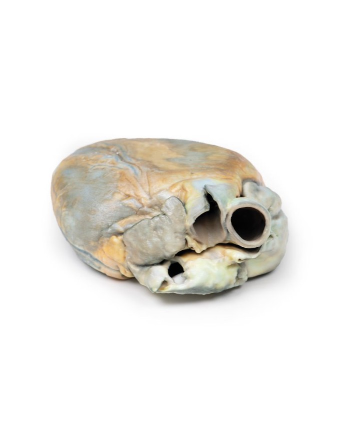 Ipertrofia ventricolare destra Erler Zimmer 3D anatomy Series MP2031