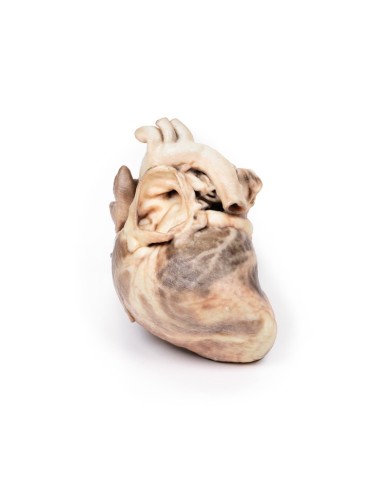 Stenosi polmonare congenita Erler Zimmer 3D anatomy Series MP2034