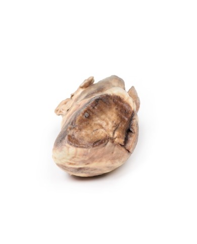 Stenosi polmonare congenita Erler Zimmer 3D anatomy Series MP2034