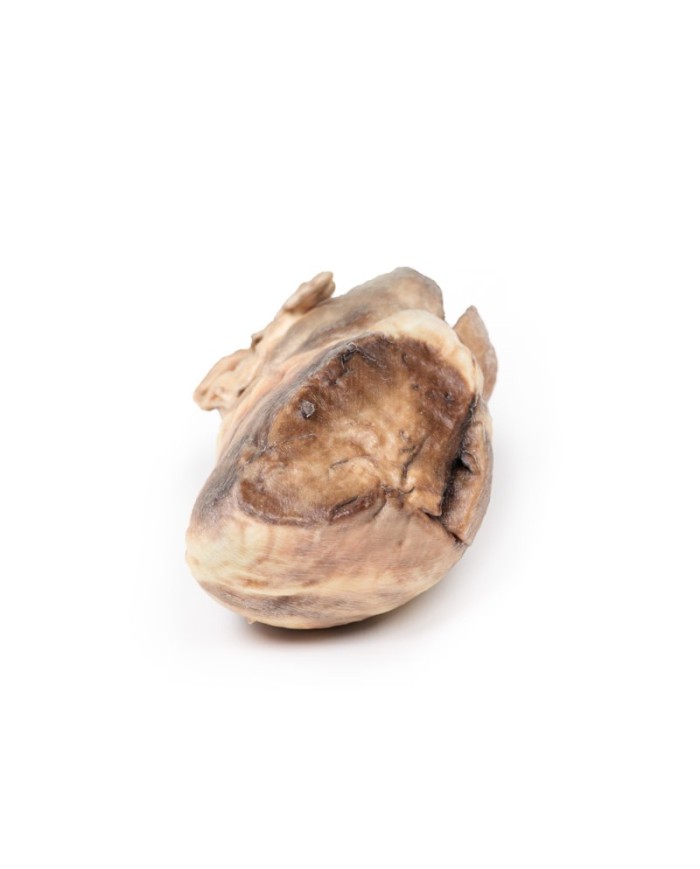 Stenosi polmonare congenita Erler Zimmer 3D anatomy Series MP2034