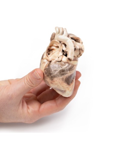 Stenosi polmonare congenita Erler Zimmer 3D anatomy Series MP2034