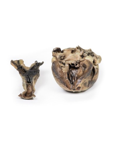 Malattia idatidea che colpisce il cuore e l aorta Erler Zimmer 3D anatomy