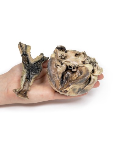 Malattia idatidea che colpisce il cuore e l aorta Erler Zimmer 3D anatomy