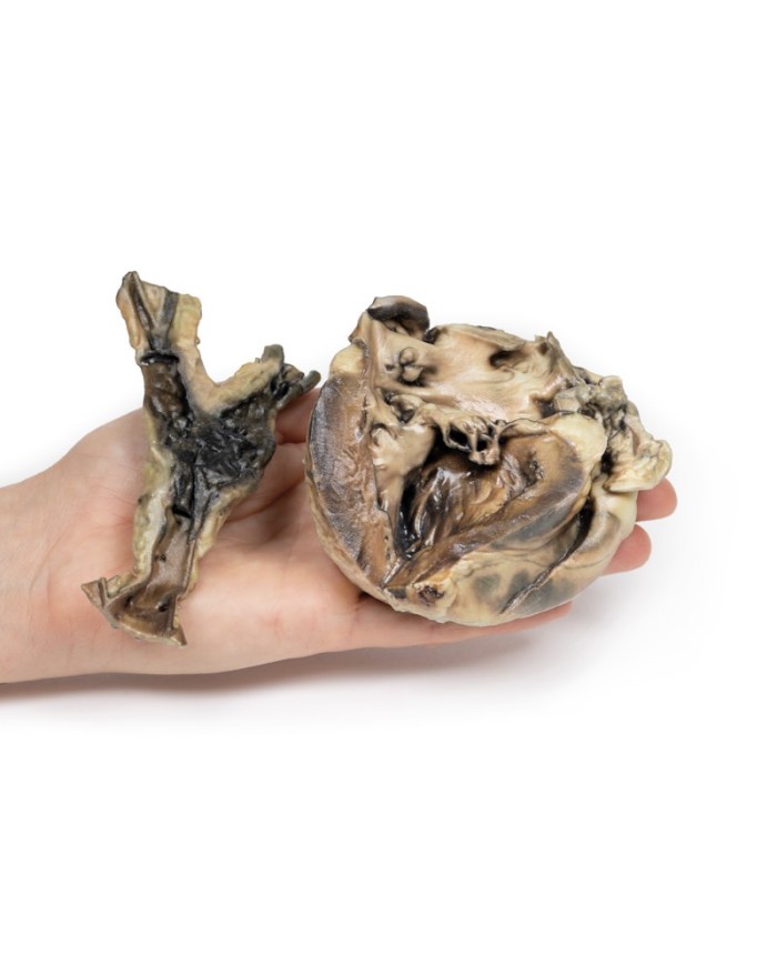 Malattia idatidea che colpisce il cuore e l aorta Erler Zimmer 3D anatomy